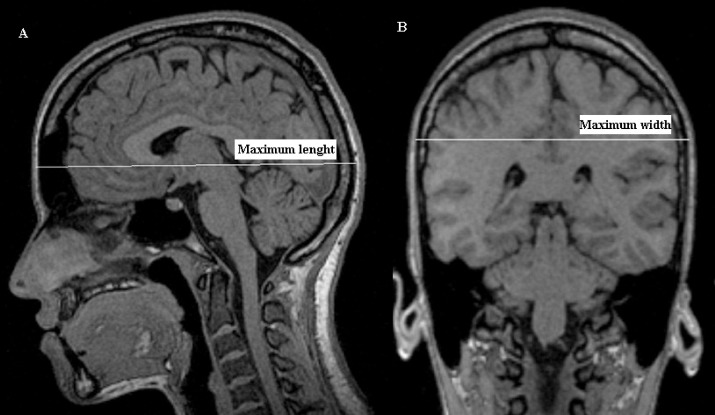 Glioma Surgery